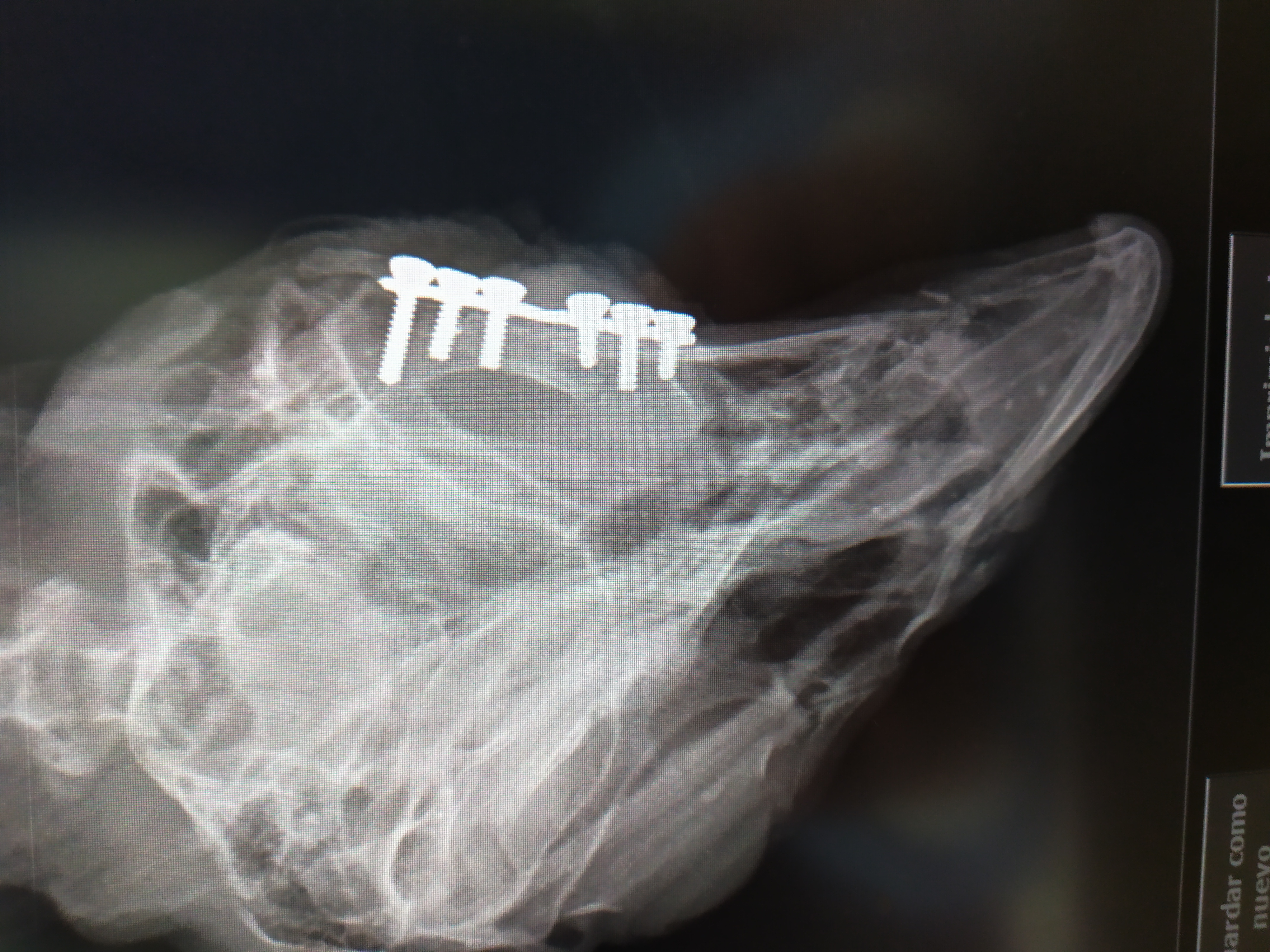 Radiografía en la que se aprecia la placa de osteosíntesis implantada. Imagen: AMUS